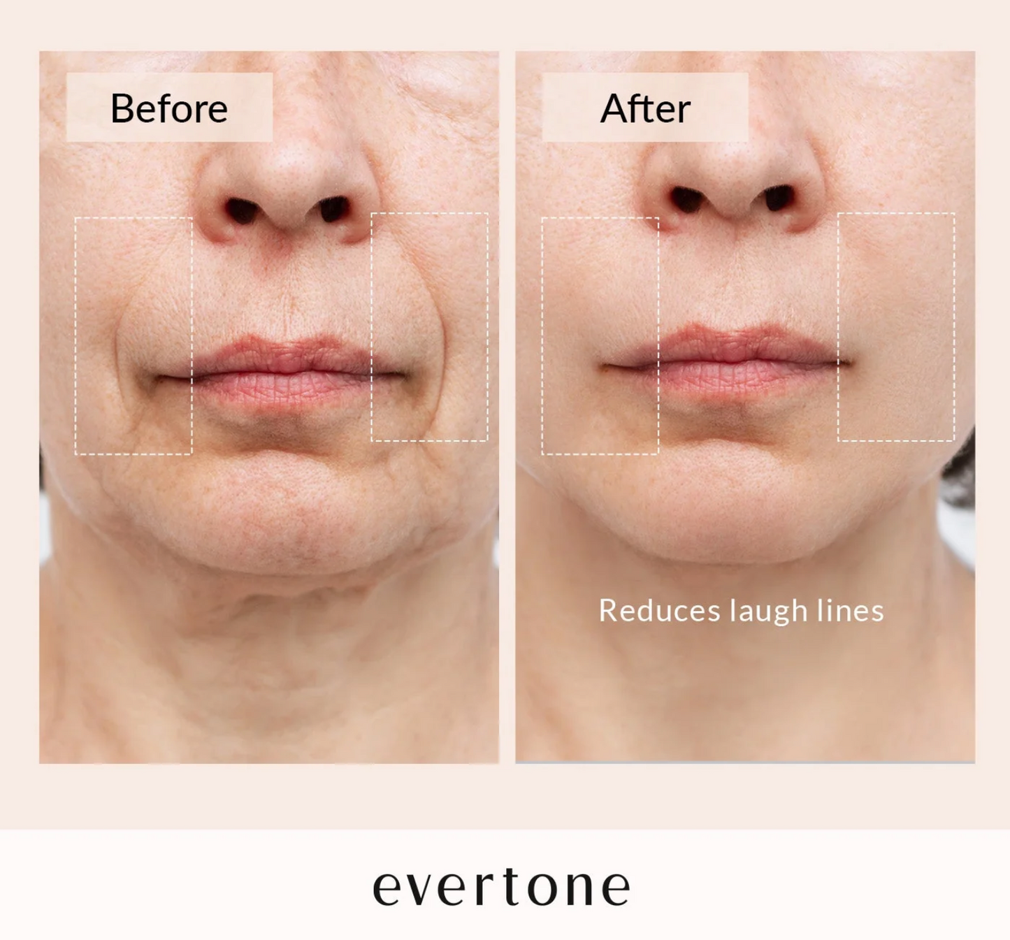 Evertone EverLift Microcurrent Facial Toning Device